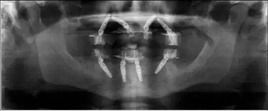 Xray of patient with Teeth in a Day from Implant & Periodontics Solutions