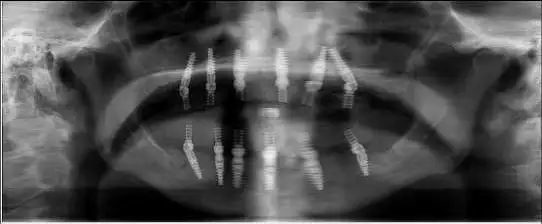 Xrays of patient after All-on-Six Treatment at Implant & Periodontics Solutions