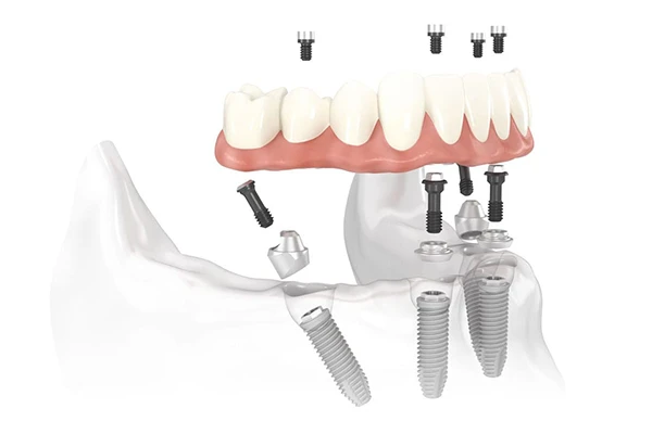 Diagram of All-on-4 Treatment Concept implant bridge placed in the jaw Diagram of All-on-4 Treatment Concept implant bridge placed in the jaw
