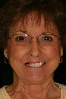 Patient before All-on-Six Treatment at Implant & Periodontics Solutions