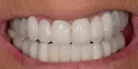smiling patient with Nobel dental implants from Implant & Periodontics Solutions