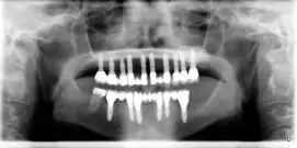 Xray of patient with Nobel dental implants from Implant & Periodontics Solutions