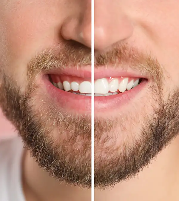 A close-up before and after of a man's mouth highlighting difference of a periodontal treatment, and healthier looking gums