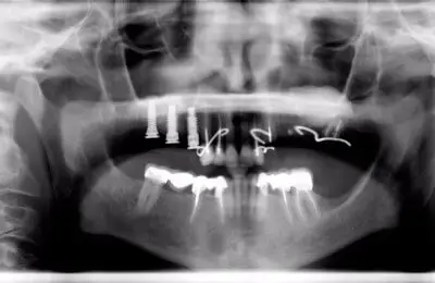 X-Ray of a patient's jaw  from Implant & Periodontics Solutions in Sun City West, AZ
