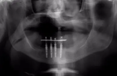 X-Ray of a patient's mouth with multiple dental implants  from Implant & Periodontics Solutions in Sun City West, AZ