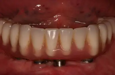 Bottom row of teeth at Implant & Periodontics Solutions in Sun City West, AZ