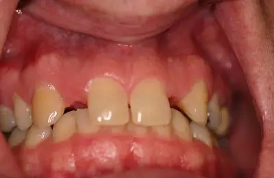 Close up of mouth with missing teeth from Implant & Periodontics Solutions in Sun City West, AZ