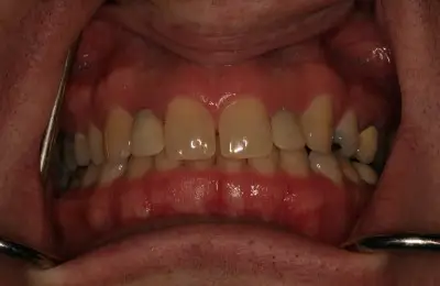 Close up of row of teeth at Implant & Periodontics Solutions in Sun City West, AZ