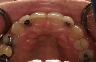 Close up of lower teeth Implant & Periodontics Solutions in Sun City West, AZ