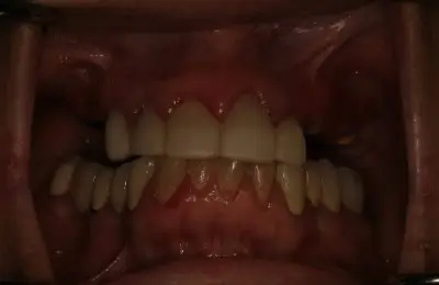 Close up of teeth at Implant & Periodontics Solutions in Sun City West, AZ