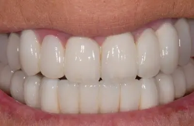 Close up of mouth and row of teeth from Implant & Periodontics Solutions in Sun City West, AZ