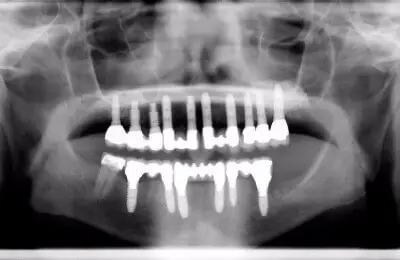X-Ray of dental implants from Implant & Periodontics Solutions in Sun City West, AZ