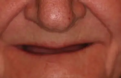 Close up of patient's mouth from Implant & Periodontics Solutions in Sun City West, AZ