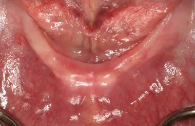 Close up mouth at Implant & Periodontics Solutions in Sun City West, AZ