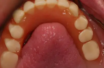Close up of lower teeth at Implant & Periodontics Solutions in Sun City West, AZ