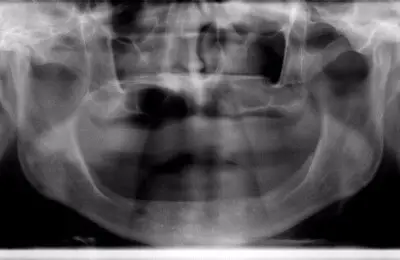 X-Ray of jaw Implant & Periodontics Solutions in Sun City West, AZ