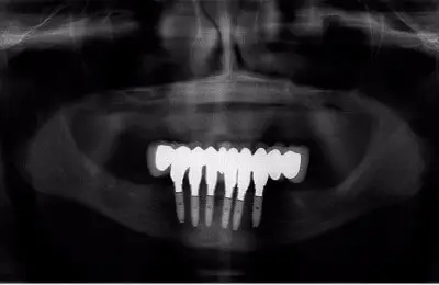 X-Ray of a patient's mouth with multiple dental implants from Implant & Periodontics Solutions in Sun City West, AZ