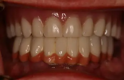 Close up of mouth from Implant & Periodontics Solutions in Sun City West, AZ