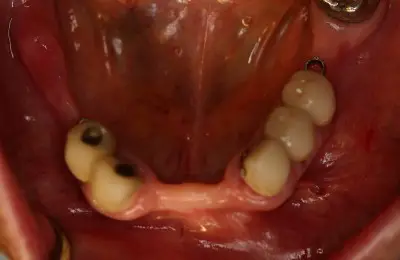 Close up of mouth with missing teeth from Implant & Periodontics Solutions in Sun City West, AZ