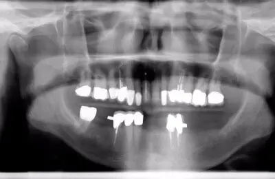 X-Ray of a patient's mouth with missing teeth from Implant & Periodontics Solutions in Sun City West, AZ