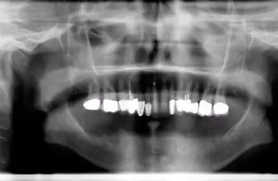 X-Ray of teeth from Implant & Periodontics Solutions in Sun City West, AZ
