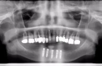 X-Ray of a patient's mouth with multiple dental implants from Implant & Periodontics Solutions in Sun City West, AZ
