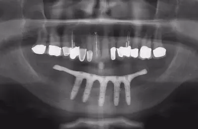 X-Ray of mouth with implants from Implant & Periodontics Solutions in Sun City West, AZ