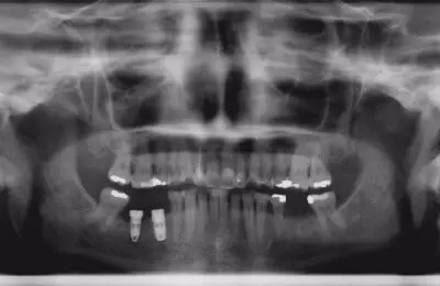 X-Ray of a patient's lower jaw with dental implants from Implant & Periodontics Solutions in Sun City West, AZ