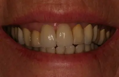 Close up of patient's mouth from Implant & Periodontics Solutions in Sun City West, AZ