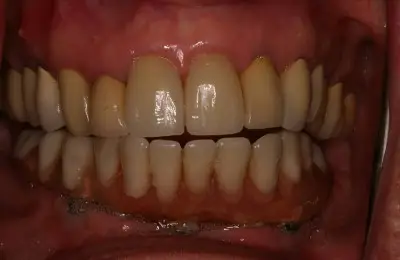Close up of mouth with teeth from Implant & Periodontics Solutions in Sun City West, AZ