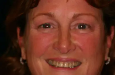 Smiling patient from Implant & Periodontics Solutions in Sun City West, AZ