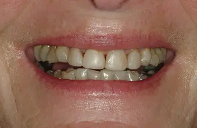 Close up of patient's smile with teeth from Implant & Periodontics Solutions in Sun City West, AZ
