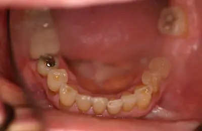 Close up of patient's mouth from Implant & Periodontics Solutions in Sun City West, AZ