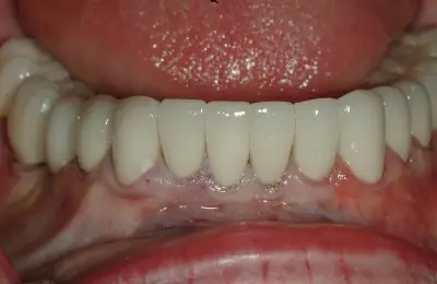 Close up of bottom row of teeth from Implant & Periodontics Solutions in Sun City West, AZ