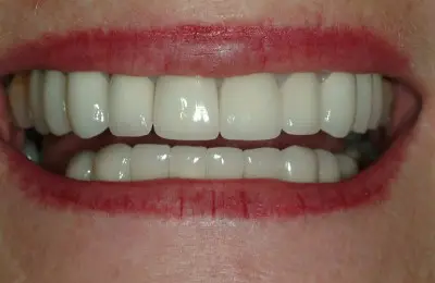 Close up of smiling mouth with both rows of teeth from Implant & Periodontics Solutions in Sun City West, AZ