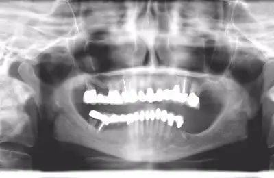 X-Ray of implants from Implant & Periodontics Solutions in Sun City West, AZ