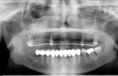 X-Ray of a patient's mouth with multiple dental implants from Implant & Periodontics Solutions in Sun City West, AZ