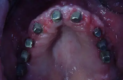 Close up of a mouth with multiple implants from Implant & Periodontics Solutions in Sun City West, AZ
