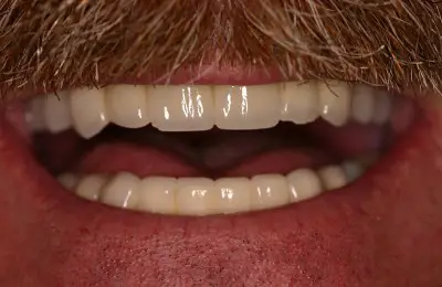 Close up of mouth with multiple dental implants from Implant & Periodontics Solutions in Sun City West, AZ