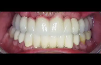 Close up of mouth with multiple dental implants from Implant & Periodontics Solutions in Sun City West, AZ