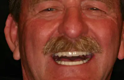 Patient smiling after getting multiple dental implants from Implant & Periodontics Solutions in Sun City West, AZ