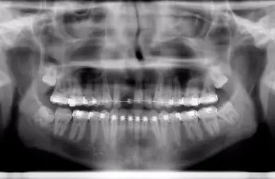 X-Ray of a patient's mouth before single tooth implants from Implant & Periodontics Solutions in Sun City West, AZ