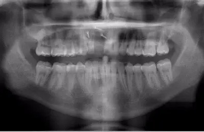 X-Ray of a patient's mouth before single tooth implants from Implant & Periodontics Solutions in Sun City West, AZ