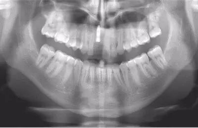 X-Ray of a patient's mouth during single tooth implants from Implant & Periodontics Solutions in Sun City West, AZ