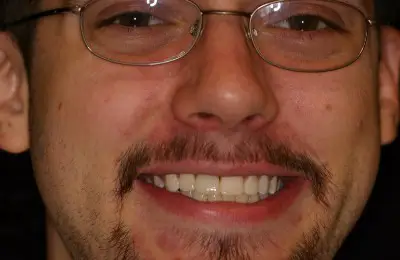 Patient smiling after getting single tooth implants from Implant & Periodontics Solutions in Sun City West, AZ