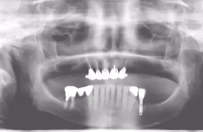 X-Ray of a mouth for a sinus bone regeneration procedure with dental implants from Implant & Periodontics Solutions in Sun City West, AZ