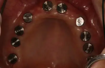 A patients mouth during a sinus bone regeneration procedure with dental implants from Implant & Periodontics Solutions in Sun City West, AZ
