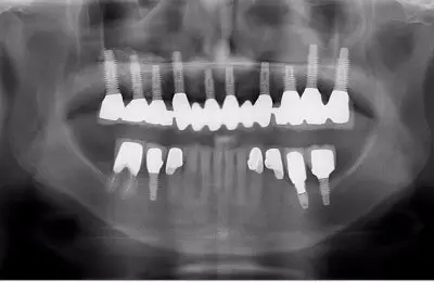 X-Ray of a patient's mouth for a sinus bone regeneration with dental implants from Implant & Periodontics Solutions in Sun City West, AZ