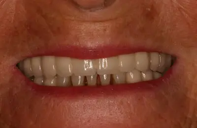 Patient smiling after a sinus bone regeneration procedure with dental implants from Implant & Periodontics Solutions in Sun City West, AZ