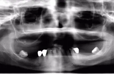 X-Ray of a patient's mouth for a sinus bone regeneration procedure with dental implants from Implant & Periodontics Solutions in  Sun City West, AZ